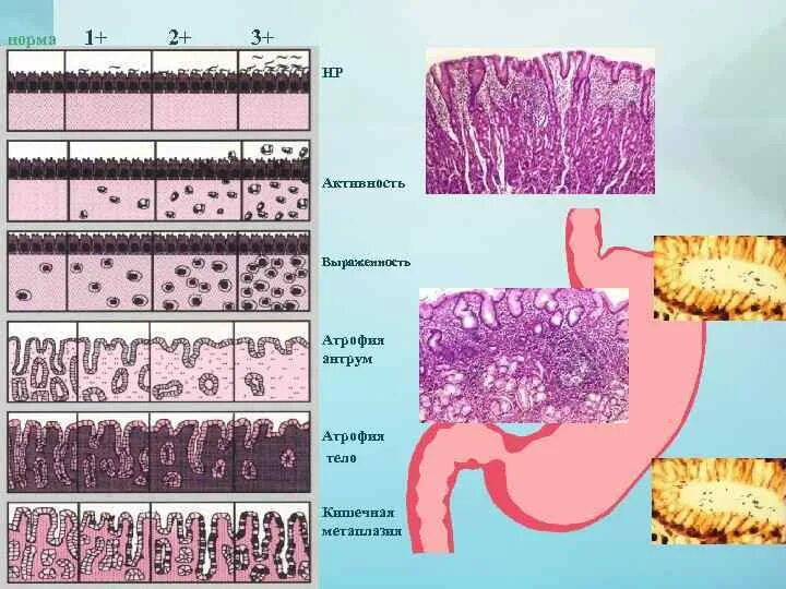 Кишечная метаплазия гистология. Кишечная метаплазия эпителия желудка гистология. Кишечная метаплазия желудка гистология. Атрофия слизистой желудка гистология. Признаки атрофией слизистой оболочки