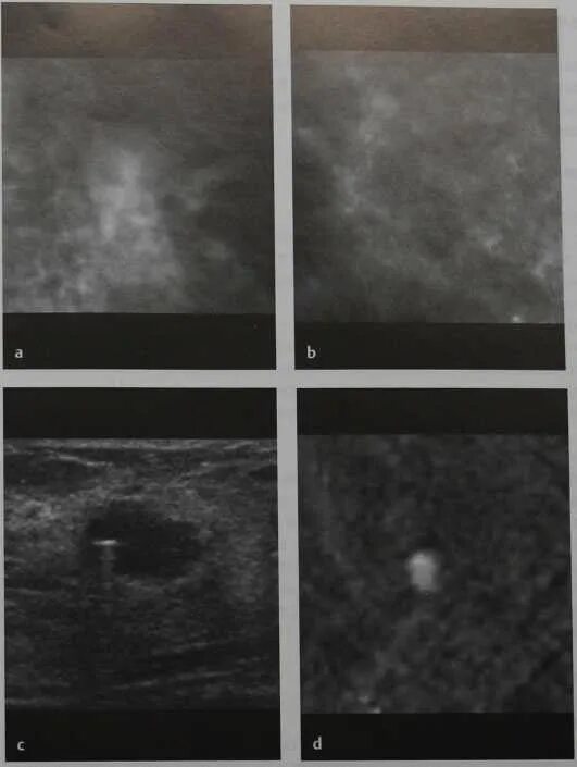 Признаки фиброзных изменений молочных. Фиброз молочной железы на УЗИ. Очаговый фиброз молочной железы на маммографии.