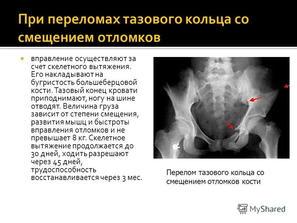 Перелом подвздошной кости таза рентген. Краевой перелом таза рентген. Перелом с нарушением тазового кольца. Вертикальный перелом таза.