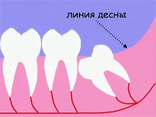 Зуб мудрости у девушек во сколько. Зуб мудрости у девушек во сколько