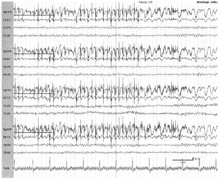 Фотомиоклонический ответ на ЭЭГ. Фотопароксизмальный ответ на ЭЭГ. Усвоение ритма фотостимуляции на ЭЭГ. Фотостимуляция при ЭЭГ расшифровка.