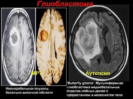 Неоперабельная опухоль