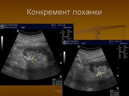 Система конкремента
