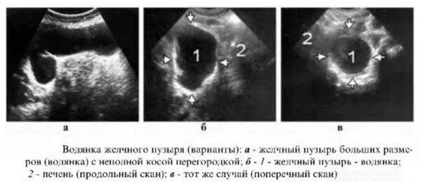 Увеличенный желчный пузырь причины. Жидкость вокруг желчного пузыря на кт. Водянка желчного пузыря кт признаки. УЗИ картина водянки желчного пузыря. Водянка желчного пузыря на кт.