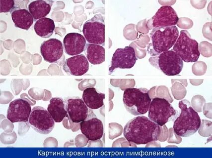 Острый лимфатический лейкоз