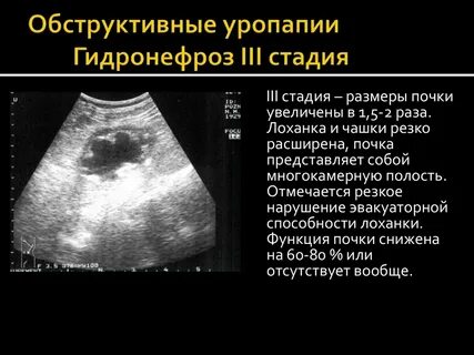 Лоханка почки у плода