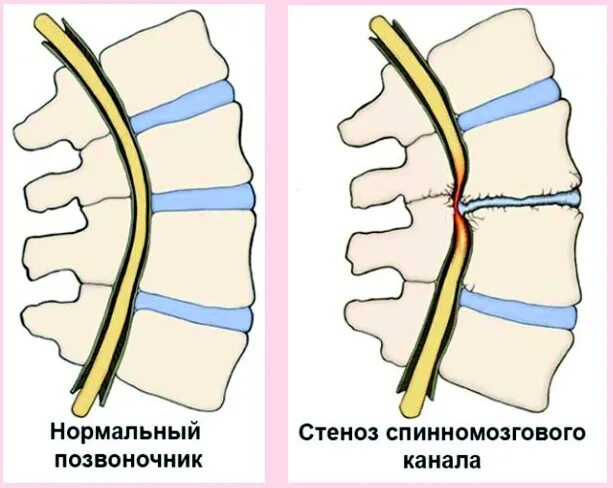 Поясничный абсолютный стеноз