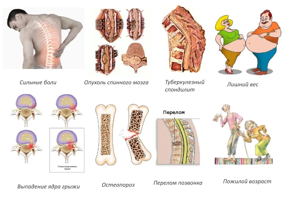 Сильные боли грыжа позвоночника. Грыжа позвоночника. Диета при позвоночной грыже поясничного отдела. Диета при межпозвонковой грыже поясничного отдела. Диета при грыже межпозвоночного диска.