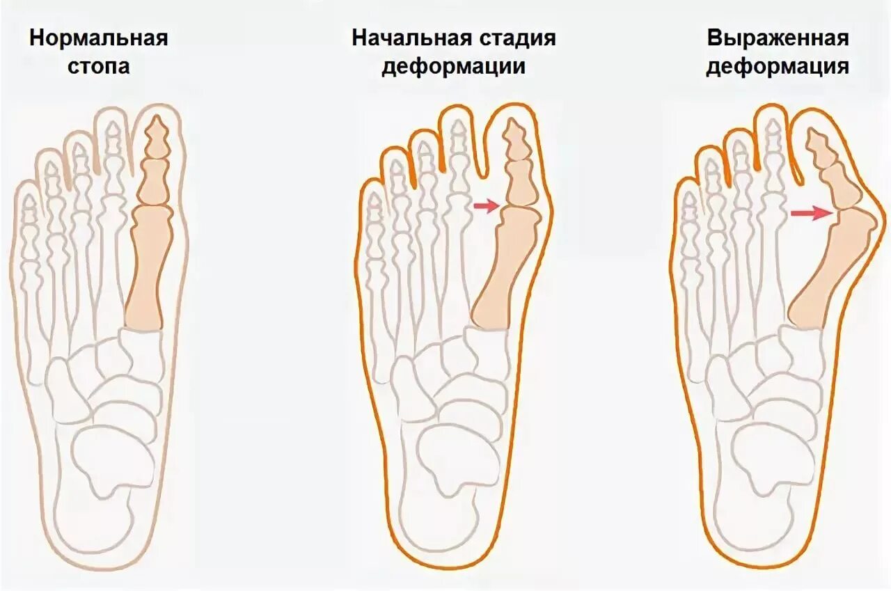 2 косточки на ноге