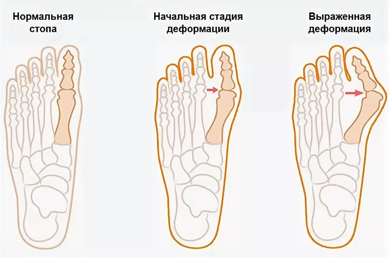 Большая косточка. Вальгусная деформация первого пальца стопы. Вальгусная деформация косточки. Степени вальгусной деформации 1 пальца стопы. Вальгусная деформация 1 пальца.