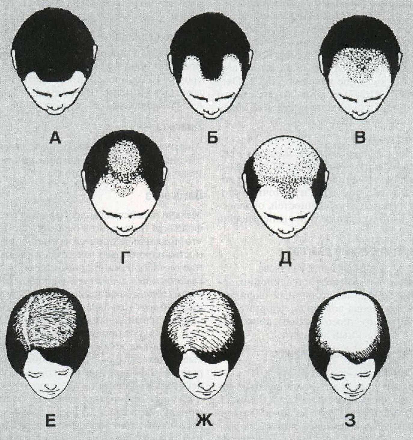 Округлая форма головы. Андрогенная алопеция алопеция. Шкала Людвига алопеция. Андрогенная алопеция Гамильтон. Андрогенная алопеция схема.
