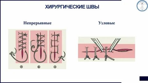 Швы на какой день