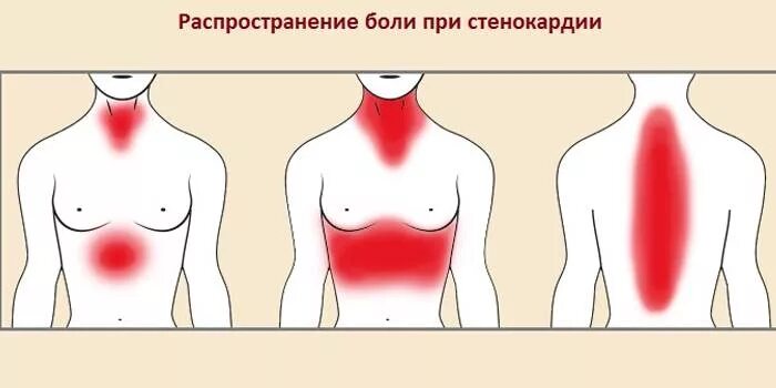 Иррадиация стенокардии. Иррадиация боли в сердце. Локализация боли при стенокардии. Локализация боли в груди. Локализация боли в сердце.