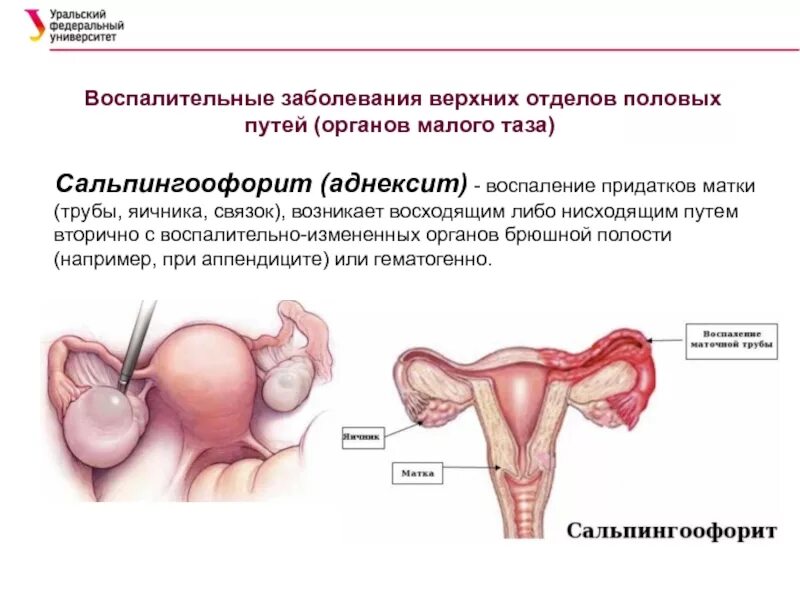 Хронический двухсторонний сальпингоофорит. Воспалительные заболевания матки и маточных труб. Подострый хронический сальпингоофорит. Хронический правосторонний сальпингоофорит. Аднексид