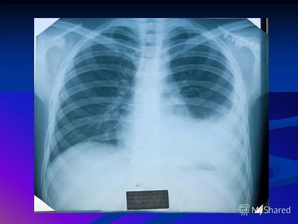 плевральный выпот слева