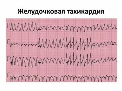 Пируэтная тахикардия