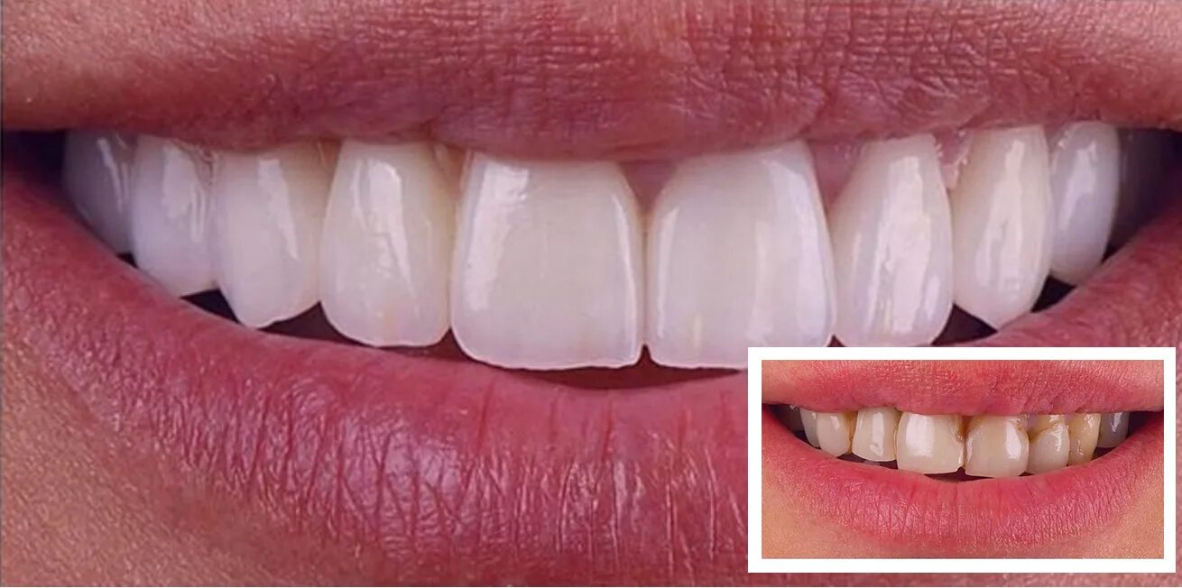 Отзывы на виниры. Композитные виниры улыбка. True smile виниры. Отзывы на виниры. Отзывы на виниры.