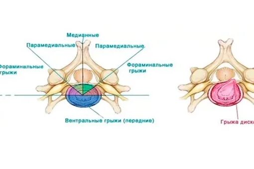 Задняя медианная протрузия. Грыжа l5-s1. Левосторонняя парамедианная грыжа л5 с1. Циркулярное выбухание диска l4/l5. Задняя медианная протрузия.