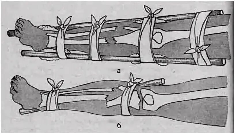 Перелом голени транспортировка. Перелом голени иммобилизация. Иммобилизация при переломе голени. Шинирование костей голени. Перелом костей голени иммобилизация.