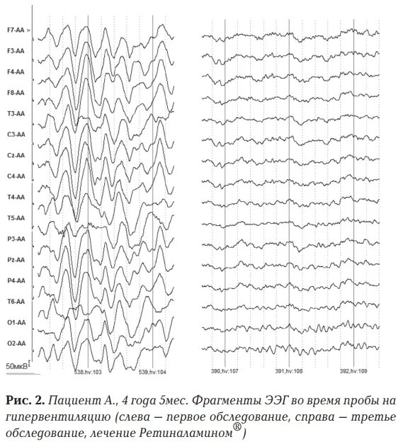 Показатели ЭЭГ для детей. Нормальная ЭЭГ У детей 5 лет. Заключение ЭЭГ норма для ребенка. ЭЭГ головного мозга нормальные показатели у ребенка. Здоровая ээг