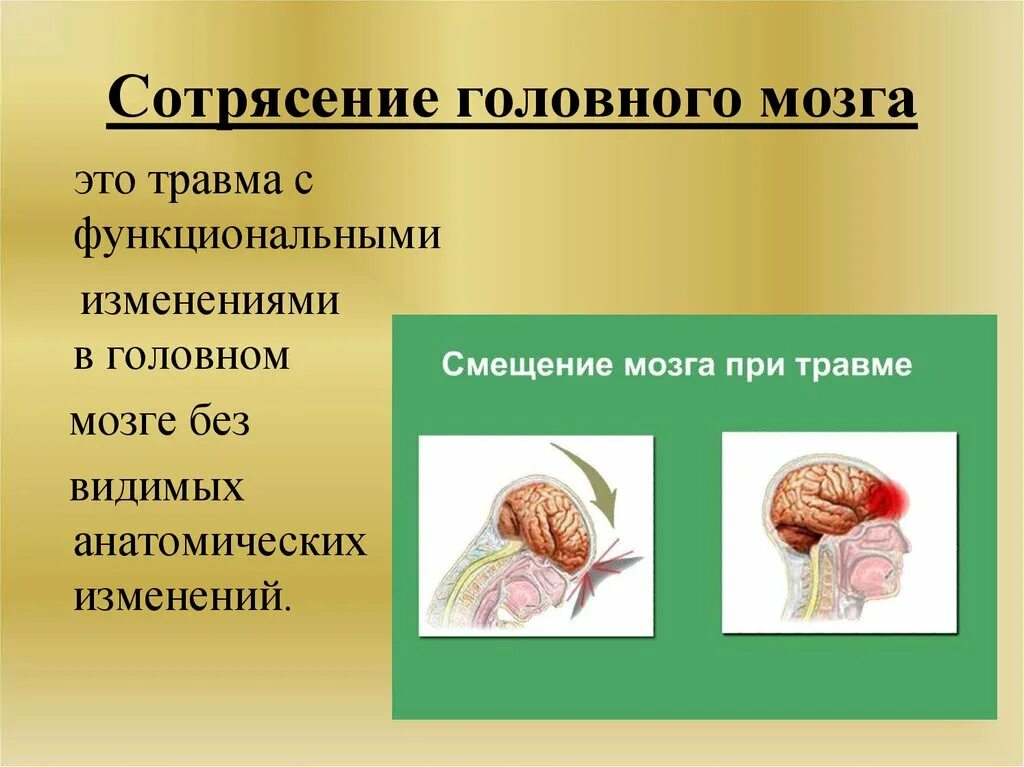 Сотрясение 1. Формы сотрясения головного мозга. Симптомом сотрясения головного мозга является.