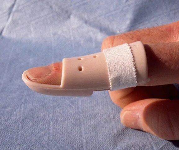 После снятия лангетки. Фиксатор сухожилия разгибателя пальца. Ортез Mallet finger. Повреждение сухожилия разгибателя пальца. Перелом ногтевой фаланги 1 пальца.