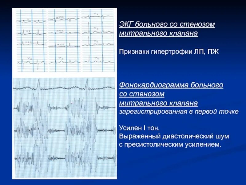 Митральный стеноз признаки. Стеноз митрального клапана ЭКГ. ЭКГ признаки митрального стеноза. ЭКГ критерии митральной недостаточности. Митральный стеноз ЭКГ.