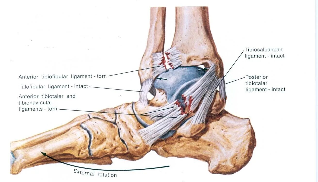 Повреждение капсульного аппарата голеностопного сустава. Капсульно-связочный аппарат голеностопного сустава. Связки голеностопного сустава и стопы анатомия. Сухожилия голеностопного сустава анатомия. Разрыв дельтовидной связки голеностопного сустава.