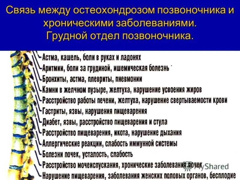 Хондроз грудного отдела симптомы и лечение