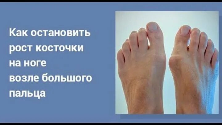 Лавровый лист для ног. Вальгус большого пальца мази мазь. Шепоток на красоту и молодость. Вальгус большого пальца мази мазь. Заговорить кольцо на удачу.
