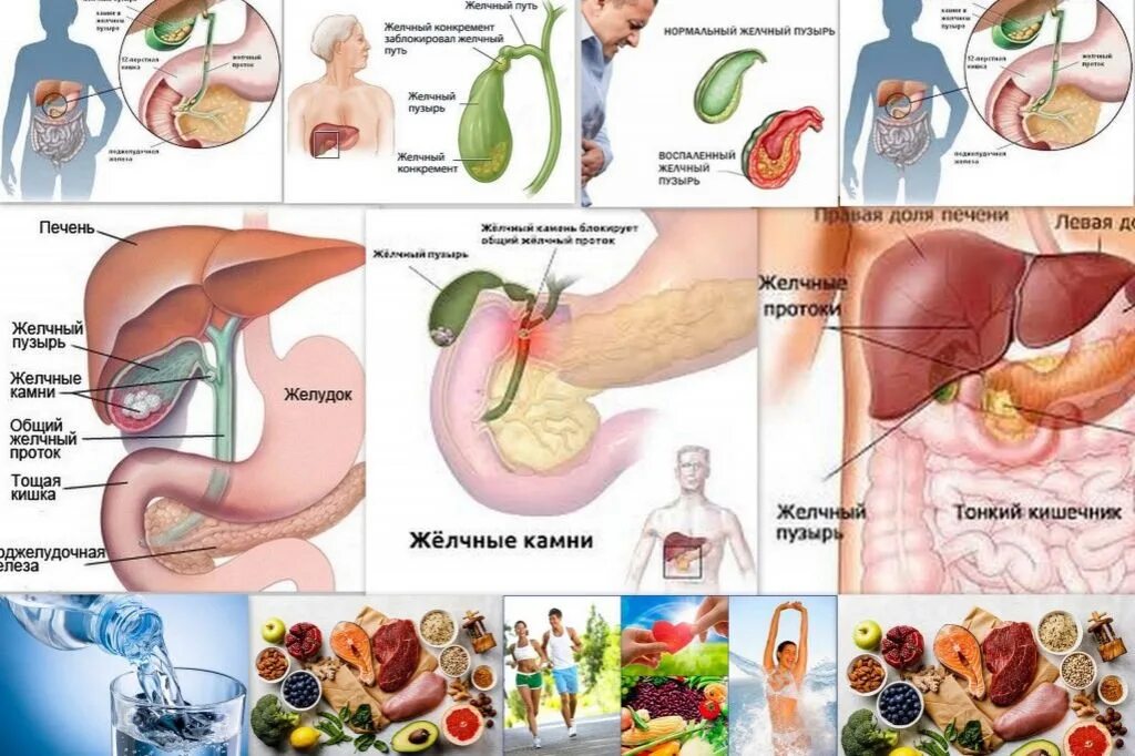 Проблемы с печенью желчным пузырем. Причины заболевания холециститом. Профилактика острого холецистита. Патология желчного пузыря. Холицистоз желчного пузыря.