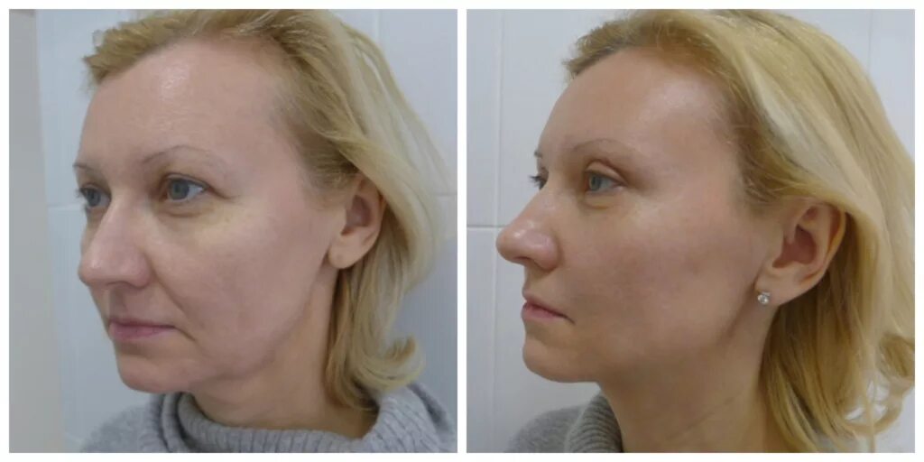 Височный лифтинг до и после отзывы Височный лифтинг до и после отзывы