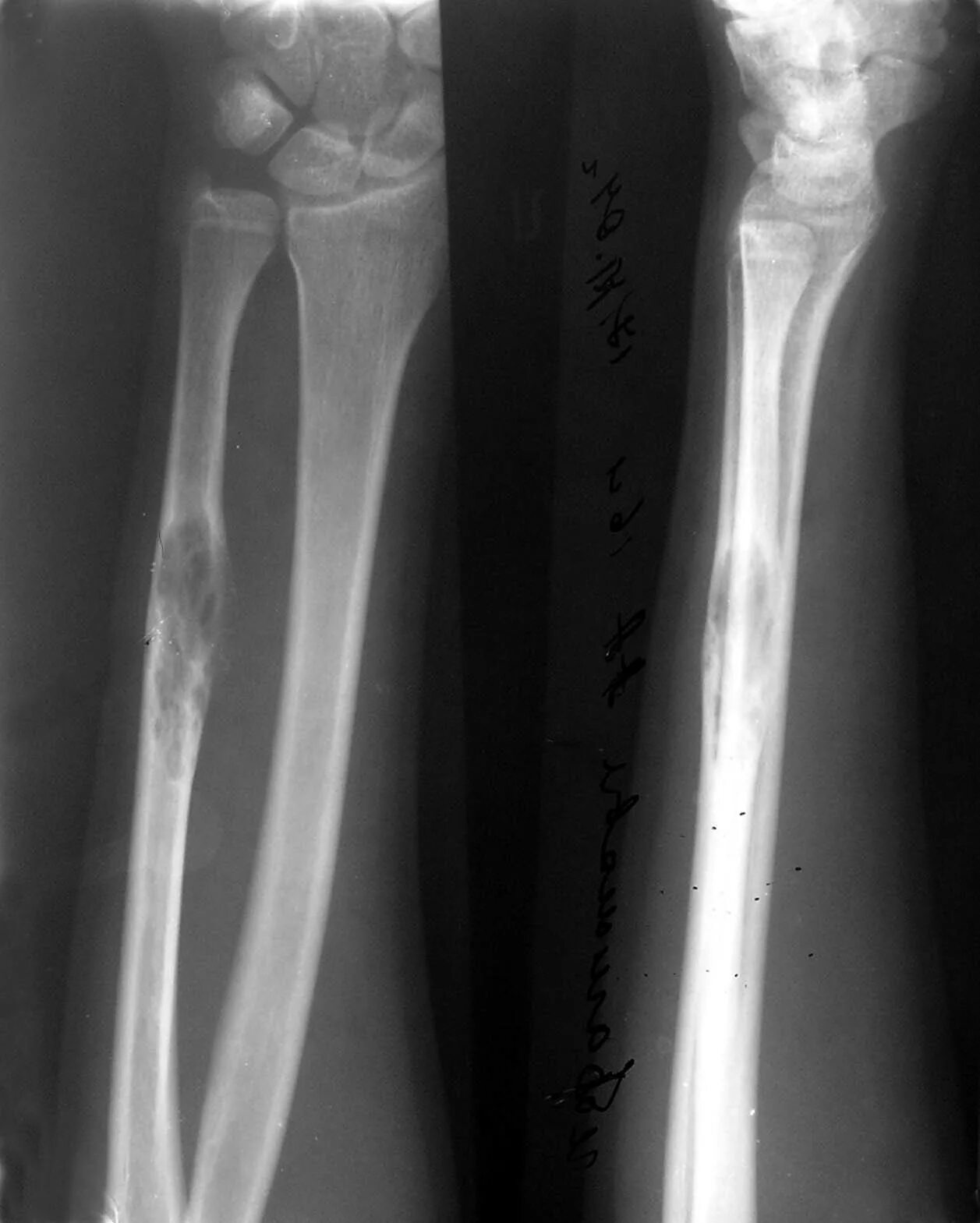 Передом симфиза локтевой. Изолированные переломы диафиза локтевой кости. Сросшийся перелом лучевой кости. Изолированный перелом диафиза локтевой кости. Оскольчатый перелом локтевой кости.