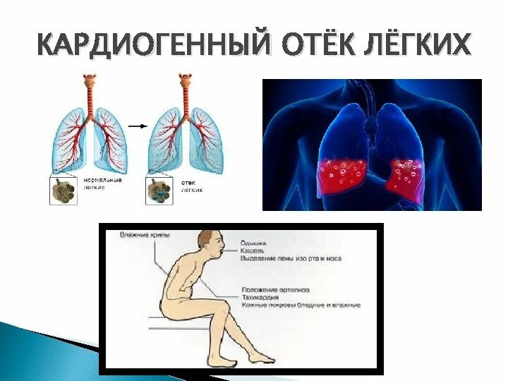 Кардиогенный отек легких патогенез. Кардиогенный отек легких механизм развития. Кардиогенный отек легкого. Кардиагенный отёк лёгких.