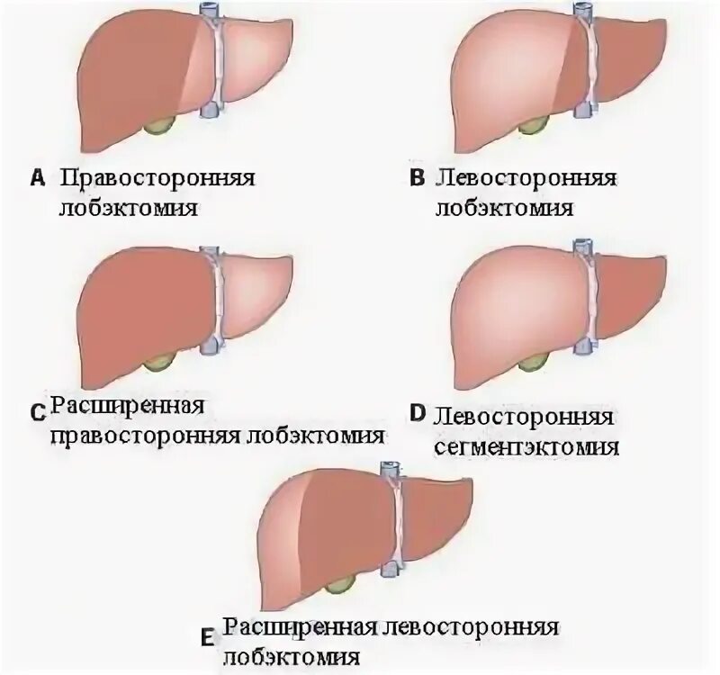 Лобэктомия – резекция доли печени;. Атипичная резекция печени этапы операции. Атипичная резекция 5 сегмента печени. Операция по иссечению доли печени. Удаление опухолей печени