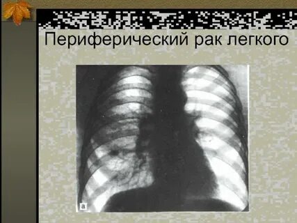 Силикоз легких