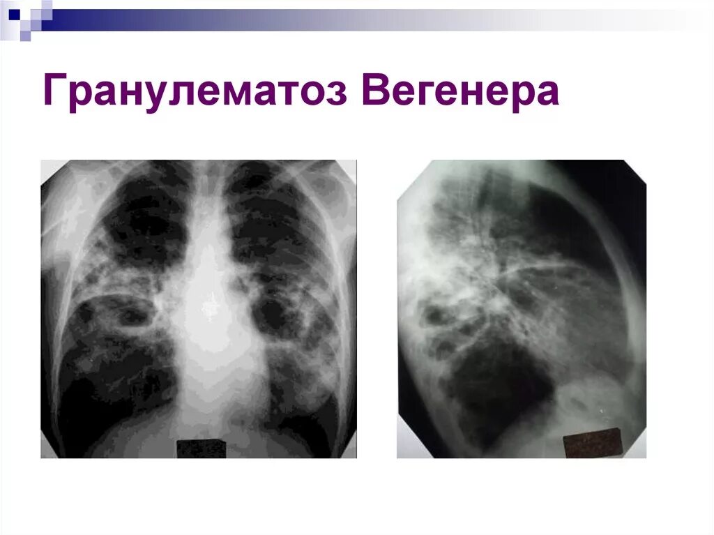 Гранулематоз лечение. Гранулематозный васкулит вегенера. системные васкулиты (гранулематоз вегенера).. гранулематоз с полиангиитом вегенера. поражение легких при гранулематозе вегенера.