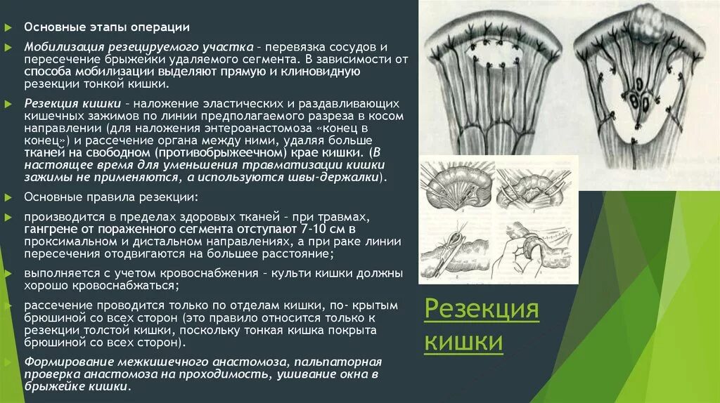 Этапы после операции. Мобилизация пораженного участка тонкой кишки. Мобилизация пораженного участка кишки и ее резекция. Резекция тонкой кишки этапы.