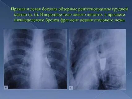 В грудной клетке инородное
