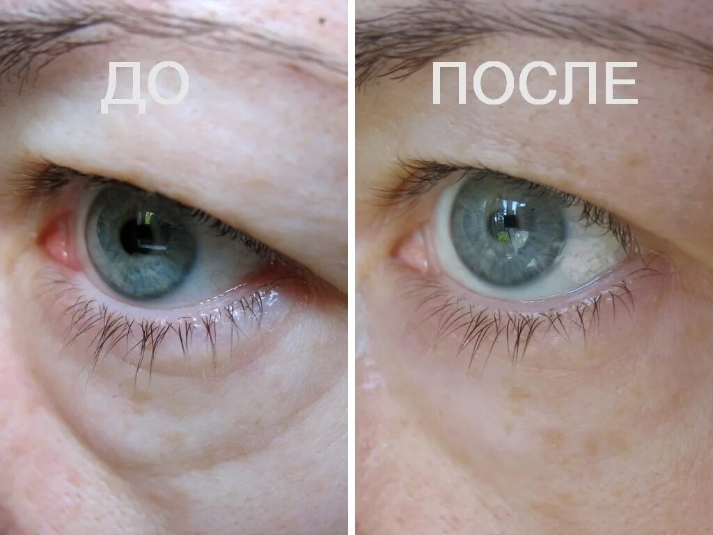 Refaltis Eyes фото до и после. Рефалтис айс для глаз. Refaltis Eyes. 5) Photozyme IQUAD total Eye Care.