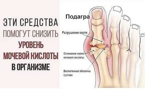 От подагры препараты кислота