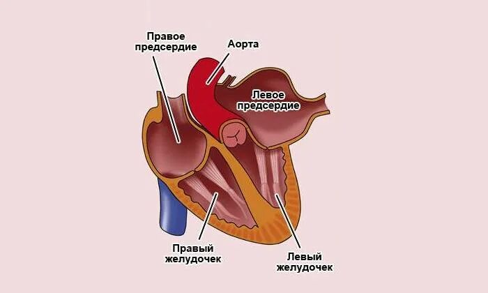 Увеличение левого предсердия. Расширенное предсердие. Расширение предсердий. Расширение левого предсердия. Дилатация полостей предсердий