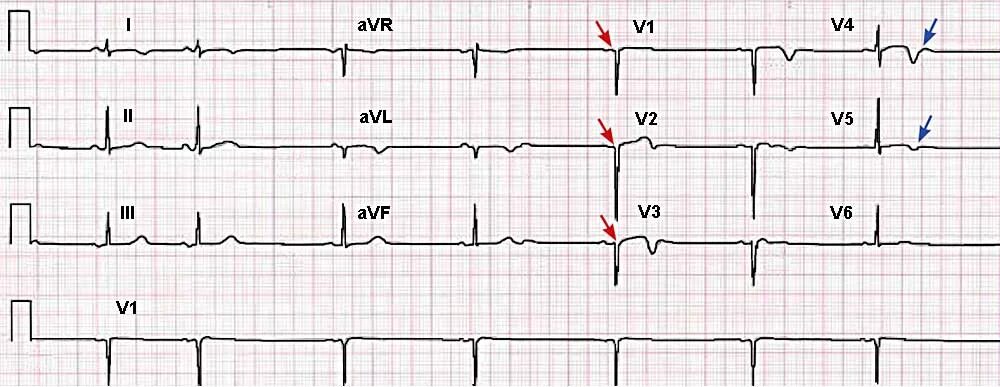 Сегмент ст на экг в норме. Инфаркт миокарда экг реципрокные изменения. Косонисходящая депрессия сегмента st на экг. Корытообразное смещение st. Сегмент st на экг в норме.
