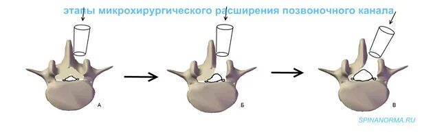 Микрохирургическая декомпрессия Корешков спинного. Декомпрессия позвоночного канала. Микрохирургическая декомпрессия позвоночного канала. Расширение позвоночного канала.