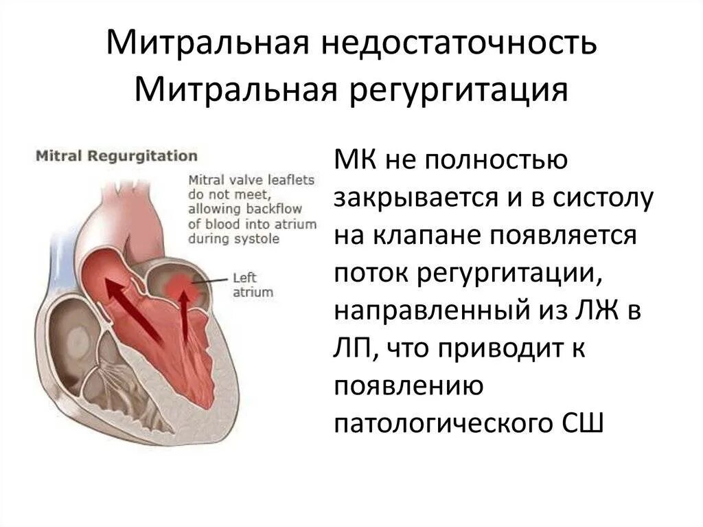 Поражение митрального клапана. Митральный клапан 1 степени. Регургитация 2 степени митрального клапана. Пролапс створки митрального клапана. Регургитация митрального клапана 1 степени что это такое.