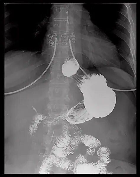 Заворот желудка рентген. Рентгеноконтрастное исследование желудка. Рентгеноскопия желудка с барием.