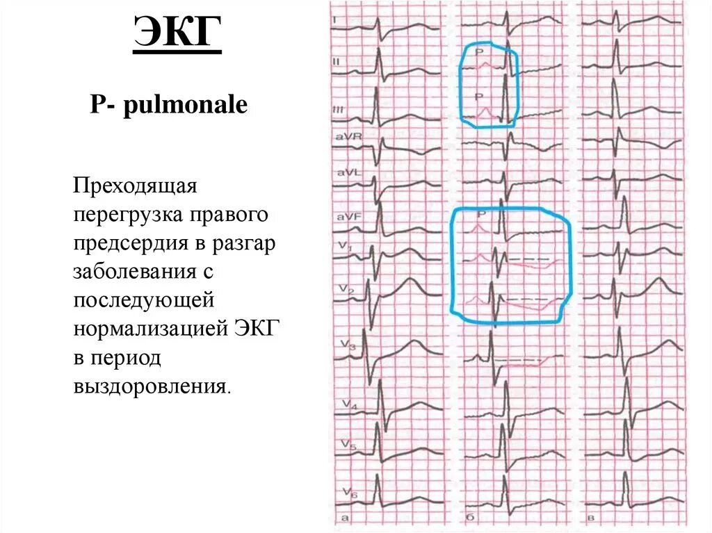 Р-pulmonale на ЭКГ. Перегрузка правых отделов сердца на ЭКГ при Тэла. ЭКГ признаки перегрузки правого предсердия на ЭКГ. Признаки перегрузки правого предсердия на ЭКГ. Перегрузка на экг что это