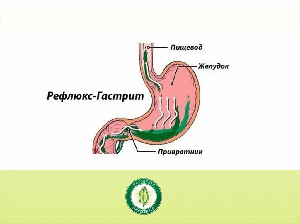 Рефлюкс 4. Гастрит рефлюкс эзофагит. Эзофагит рефлюкс кислотный. Билиарный рефлюкс-гастрит и рефлюкс-эзофагит симптомы что это такое. Дуоденогастроэзофагеальный рефлюкс.