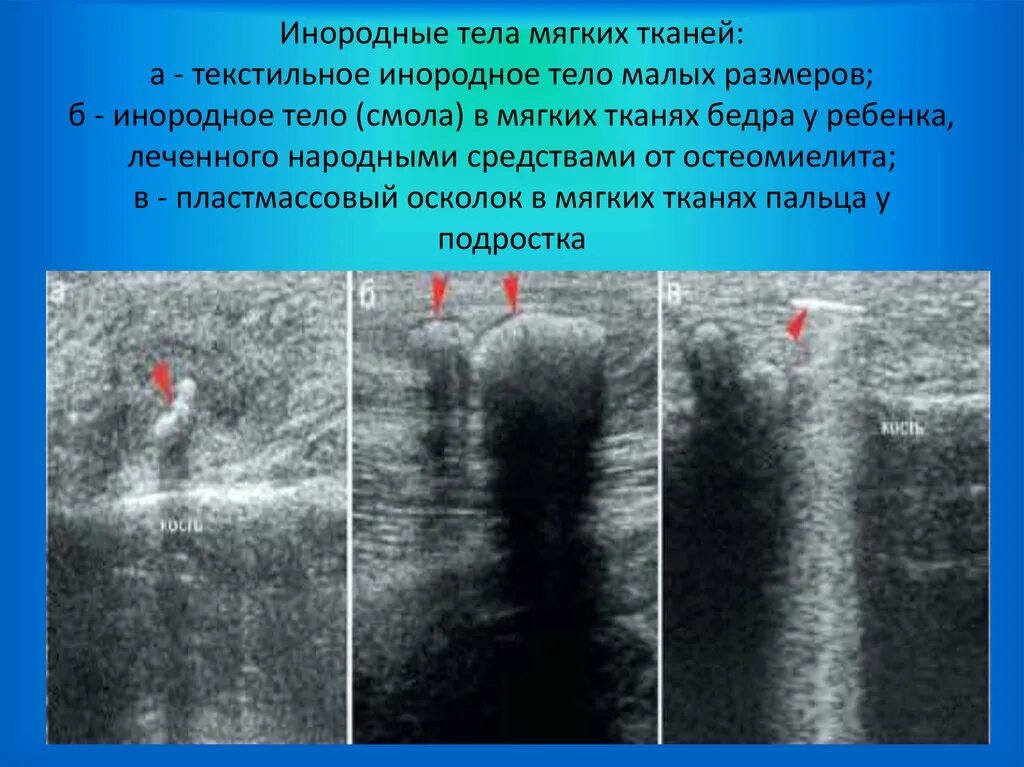 Инородное тело брюшной полости после операции. Инородное тело мягких тканей мкб 10. Инородное тело мягких тканей УЗИ. Осколки в мягких тканях.