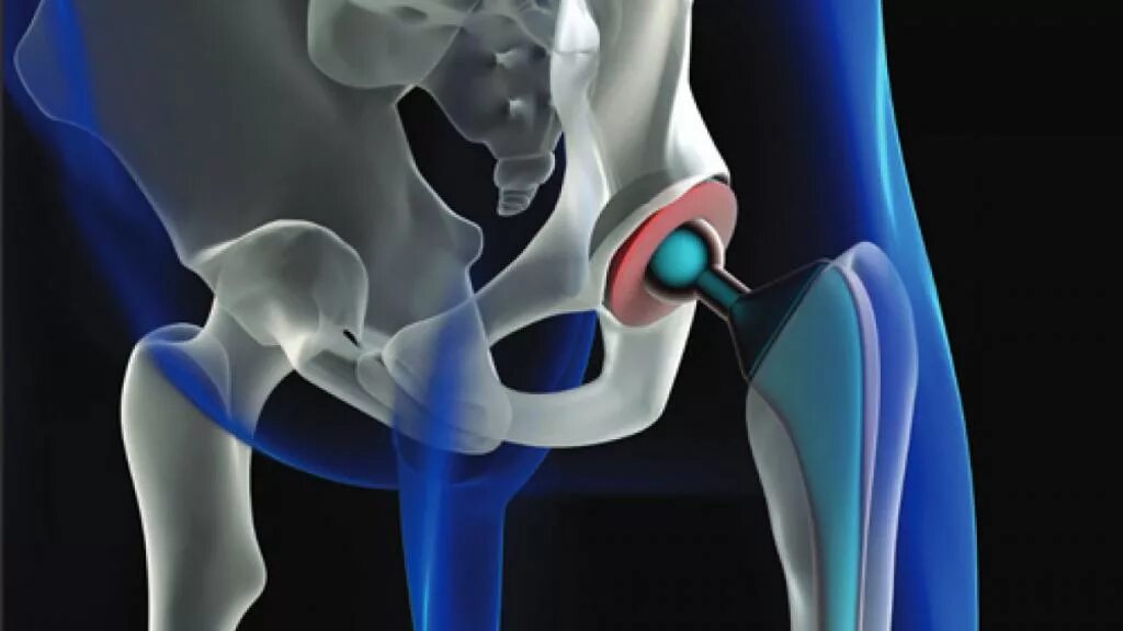 Эндопротезирование шейки бедра. Операция эндопротезирование шейки бедра. Тазобедренный перелом шейки бедра. Эндопротез тазобедренного сустава перелом шейка. Замена сустава шейки бедра